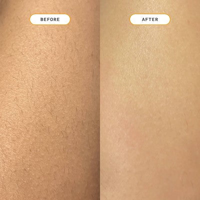 Nood Ingrown Hair Treatment The Eraser - New This is Beauty US
