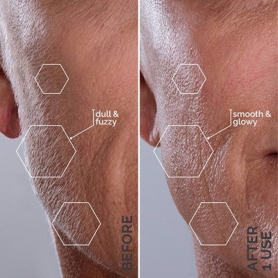 Spa Sciences SIMA Deluxe Sonic Dermaplaning Tool for Exfoliation & Peach Fuzz Removal - Imperfect Box This is Beauty US
