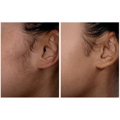 Spa Sciences SIMA Deluxe Sonic Dermaplaning Tool for Exfoliation & Peach Fuzz Removal - Imperfect Box This is Beauty US
