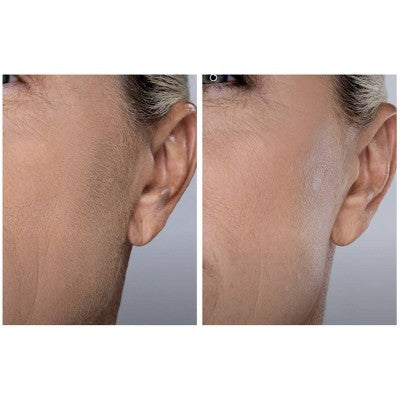 Spa Sciences SIMA Deluxe Sonic Dermaplaning Tool for Exfoliation & Peach Fuzz Removal - Imperfect Box This is Beauty US