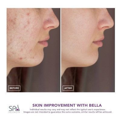 Spa Sciences BELLA 3-in-1 Diamond Tip Microdermabrasion System - New This is Beauty US