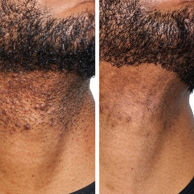 Urban Skin Rx Men's Daily Razor Bump + Dark Spot Treatment 1.7 fl oz - New This is Beauty US